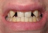 Dental Implants to Replace Missing Teeth