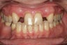 Aesthetic Implants Replace Missing Front Teeth