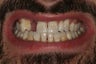 Smile Makeover: Veneers and a Bridge