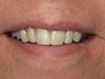 Internal Bleaching and Bonding