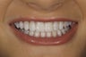 Resin bonding smile makeover on a teenager.