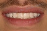 Direct Composite Resin Veneers