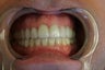 preventative decay treatment