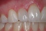 Direct Bonding (veneer)