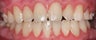 composite bonding