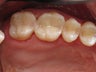 Mercury Silver filling replacment