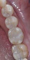 Mercury Silver filling replacement