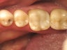 Mercury Silver filling replacement