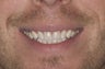 Composite Bonding and Porcelain Crowns
