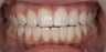 Porcelain Veneers and Composite Bonding