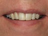 Teeth Bonding