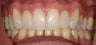 Cosmetic bonding and gum lift