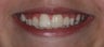 Cosmetic Composite Resin for Broken Front Tooth in Teenager