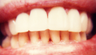 Dental Bonding