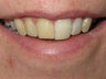 Internal Bleaching and Bonding
