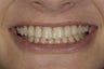 Resin bonding smile makeover on a teenager.