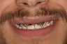 Direct Composite Resin Veneers