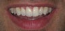 Cosmetic Bonding and gumlift