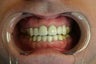 preventative decay treatment