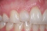 Direct Bonding (veneer)