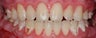 composite bonding
