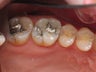 Mercury Silver filling replacment
