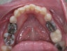 Mercury Silver filling replacment