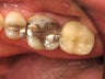 Mercury Silver filling replacement