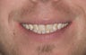 Composite Bonding and Porcelain Crowns