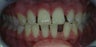 Porcelain Veneers and Composite Bonding