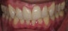 Cosmetic bonding and gum lift