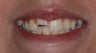 Cosmetic Composite Resin for Broken Front Tooth in Teenager
