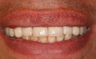 Full Porcelain Crowns