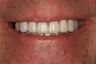 Full Porcelain Crowns