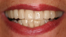 Full Porcelain Crowns