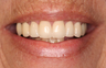 Full Porcelain Crowns