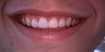 Veneers and crowns