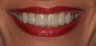 Combination of Veneers and Crowns