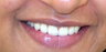 Ceramic Crowns for midline gap