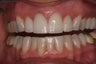 porcelain crowns