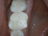 Silver Fillings Replaced with Porcelain