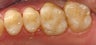 CEREC Restorations