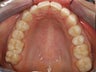 CEREC Restorations
