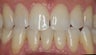 EMAX crown and extreme whitening treatment.
