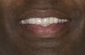 Porcelain Crowns