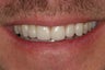 Dental Crown