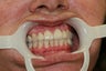 Upper anterior crowns