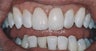 Dental Crowns and Teeth Whitening