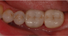 Dental Crowns