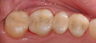 Dental Crowns and Tooth Colored Fillings